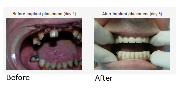 Dental Implant Restoration